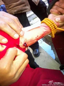 Gunshot wound sustained by a monk (Phayul.com)